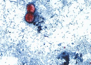 Nuovo focolaio di ciclosporiasi negli Usa: 72 casi