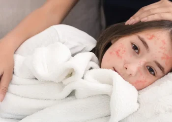 Morbillo, un antivirale blocca la trasmissione nei furetti