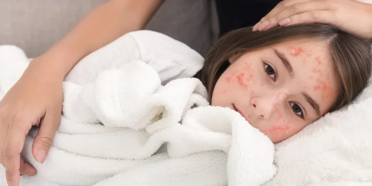 Morbillo, un antivirale blocca la trasmissione nei furetti